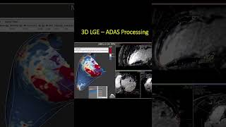 Cómo la Resonancia Cardíaca y el Software ADAS Transforman la Ablación de Taquicardia Ventricular [upl. by Akkinahs258]