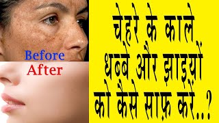 चेहरे के काले धब्बे और झाइयों कैसे साफ़ करें  How to remove Dark Spots Maharshi Ayurveda India [upl. by Eillas869]