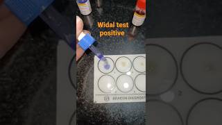 Serological practical WIDAL test typhoidfever trending practical pathology shorts [upl. by Ardath386]