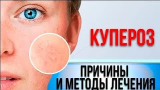 Лечение КУПЕРОЗА на лице в домашних условиях Купероз  что это  Смотри и Знай [upl. by Limay]