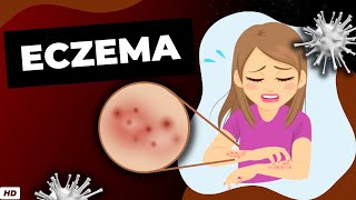 Eczema Everything You Need To Know [upl. by Viddah]