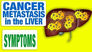 Cancer Metastasis in the Liver  All Symptoms [upl. by Arndt]