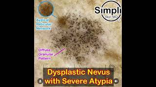 Severely Dysplastic Nevus Dermoscopy [upl. by Alamac]