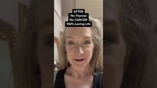 Thyroidcancer before after Thyroid thyroidectomy hypothyroidism hashimotos thyroidweightloss [upl. by Nnylg709]