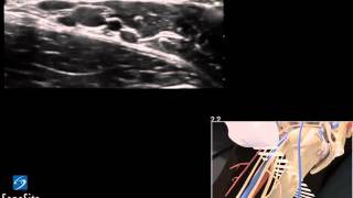 3D Lehrvideo Ultraschallgestützte Axilläre regionale Nervenblockade  SonoSite Ultraschall [upl. by Lilybelle]