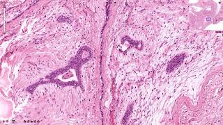 Fibroadenoma  Histopathology [upl. by Faulkner]