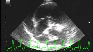 multifocal Ventricular Tachycardia with Right Atrial mass [upl. by Atter157]