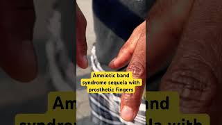 Amniotic band syndrome fredisidro fbvideo amnioticbandsyndromeprostheticfingers [upl. by Hartfield]