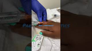 Infiltrating a Wound with Local Anesthetic before suturing [upl. by Shaughn]