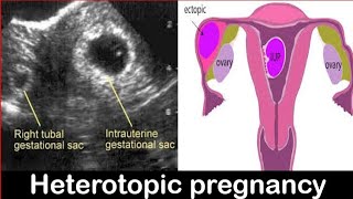 Heterotopic Pregnancy Diagnosis on Ultrasound Made EASY [upl. by Airreis]