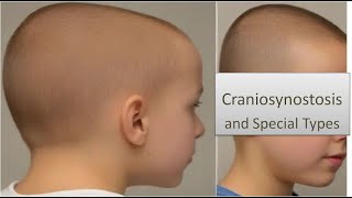 Craniosynostosis and Special Types [upl. by Eellah]