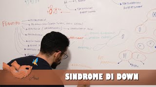 Sindrome di Down Trisomia 21 [upl. by Nedrah274]