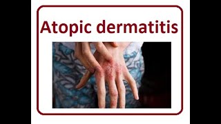 Atopic Dermatitis Symptom  2024 [upl. by Lleynod]