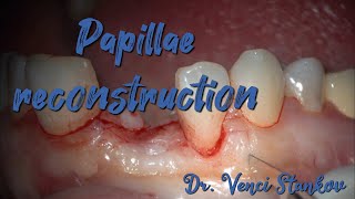 Papillae reconstruction in dental practice Dental surgery operation Dr Venci Stankov [upl. by Gathers]