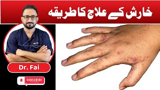 Scabies Treatment Symptoms Diagnosis Permethrin Lotion Dermatology Medicine Lectures  DrFai [upl. by Anelec]