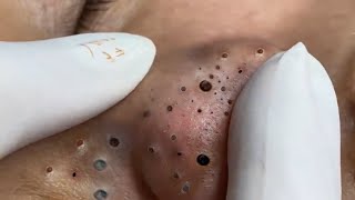 Blackheads and Hidden Acne [upl. by Aitenev]