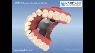 Protez Diş Fiyatları Ve Genel Bilgi [upl. by Aeslahc513]