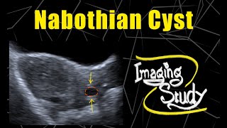 Nabothian Cyst  Ultrasound  Case 70 [upl. by Nitsuj]