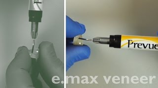 Predictable Porcelain Veneer Cementation [upl. by Pascasia]