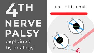 Fourth Nerve Palsies  Animation  Explained Conceptually [upl. by Ursal]