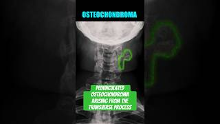 Osteochondroma of the Cervical Spine bones radiology anatomy [upl. by Harrat]