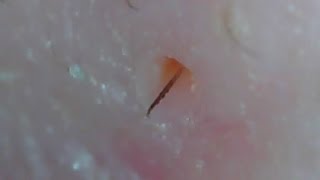 Close Up The Moment Pores Close  Blackheads Removal [upl. by Carmencita]