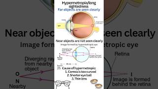 Far sightedness or hypermetropia class 10 class10 physics humaneye hypermetropia convexlens [upl. by Ekaterina305]