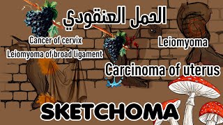 10 Sketchoma  pathology practical  Uterus leiomyoma  Carcinoma  vesicular mole [upl. by Beauvais999]