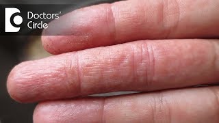 Difference between atopic dermatitis and eczema  Dr Rashmi Ravindra [upl. by Seuqirdor]