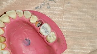 Amalgam restoration for maxillary first molar [upl. by Fortier]