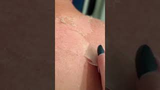 Skin peel after sunburn [upl. by Atinuaj326]