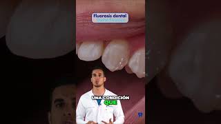 ¿Tienes MANCHAS en los dientes Podría ser FLUOROSIS dental [upl. by Arrec]