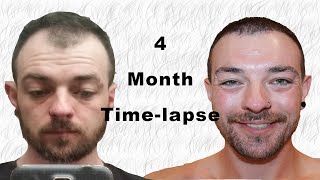 Hair Transplant Timelapse 04 months [upl. by Farrish]