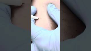 Relaxing electrolysis hair removal Zap hairs with me [upl. by Audrie]