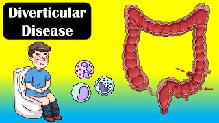 Diverticular Disease And Diverticulitis  Causes Signs amp Symptoms Diagnosis Treatment [upl. by Assilana]