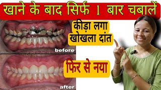 सिर्फ 1 बार चबा लो कीड़ा लगा खोखला दांत फिर से नया Tooth Cavity [upl. by Vlad]