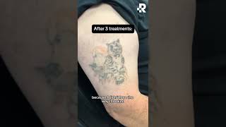 Before amp After Tattoo Removal [upl. by Etnahsa]