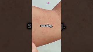 Aquagenic Urticaria The Rare Water Allergy Explained😱curiosity allergy [upl. by Wemolohtrab]