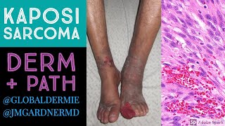 Kaposi Sarcoma DermatologyPathology Collaboration by globaldermie amp JMGardnerMD [upl. by Letnoj]