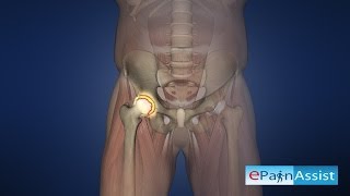 Hip Joint Arthroscopy To Know The Cause Of Hip Pain [upl. by Bridges]