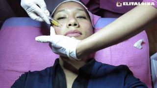 Vampir Facial Cara Hilangkan Bopeng dan Bekas Jerawat  The Aesthetic Bintaro [upl. by Htomit]