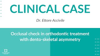 CLINICAL CASE  Occlusal check in orthodontic treatment with dento skeletal asymmetry [upl. by Purity]