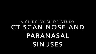 HOW TO read CT scan of Nose and Paranasal sinus a slice by slice illustration [upl. by Halley]