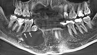 Enucleation of dentigerous cyst  dentistry  surgery  cyst  supernumerary teeth  amazing [upl. by Odlanyar899]