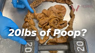 How Much Poop Is Stored in Your Colon [upl. by Dnamron]