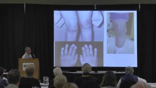 Inflammatory Arthritis Types and Treatments [upl. by Tezzil]