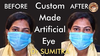 Best Artificial Eye With Eye Movements  Prosthetic eye by Dr Sumitra  Best Ocularist पत्थर का आँख [upl. by Celestina]