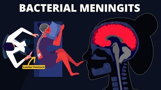 Bacterial Meningitis  Symptoms Diagnosis Treatments amp Pathology [upl. by Aynatal350]