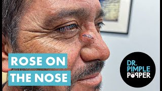 Dr Pimple Popper Opens A Rose on the Nose [upl. by Eugenia]