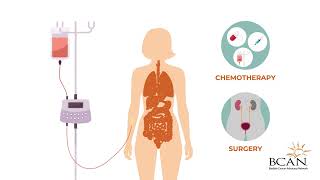 Treating Upper Tract Urothelial Carcinoma UTUC [upl. by Clements]